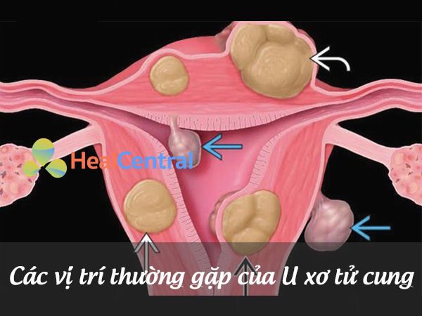 Các vị trí thường gặp của U xơ tử cung