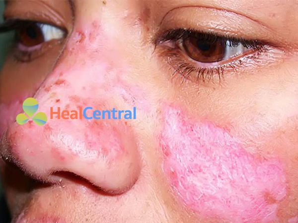 Chloroquin cũng được dùng trong điều trị lupus ban đỏ