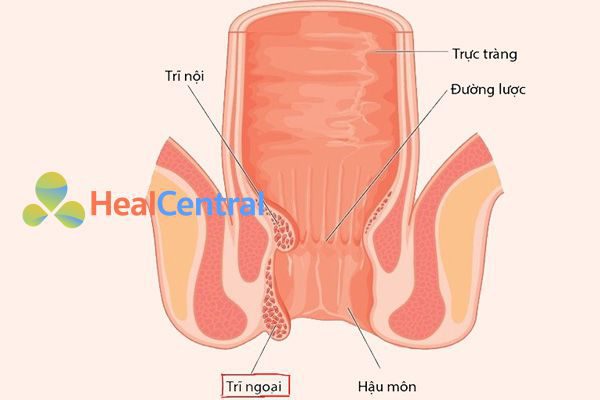 Trĩ Nội và Trĩ Ngoại