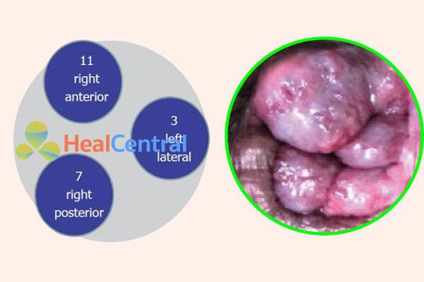 Sơ đồ các vị trí phổ biến của hậu môn chính và trĩ nội. A: Sơ đồ các vị trí phổ biến của đệm hậu môn chính. B: Các vị trí phổ biến của trĩ nội.