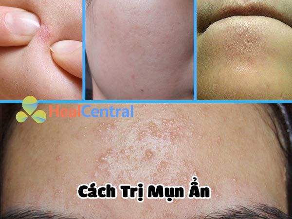 Cách trị mụn ẩn tại nhà