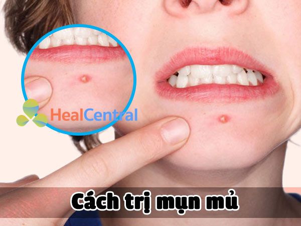 Cách trị mụn mủ sưng đỏ hiệu quả tại nhà không để lại vết thâm