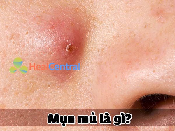 Mụn mủ là gì?