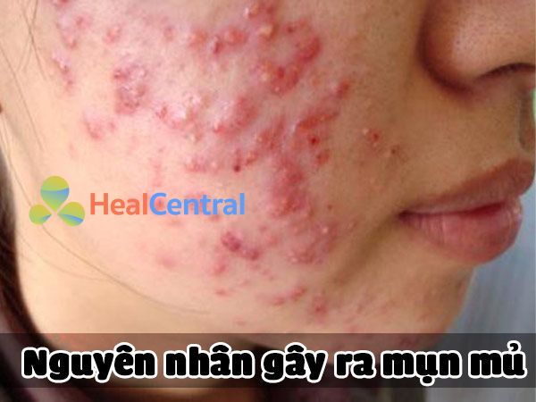 Nguyên nhân gây ra mụn mủ