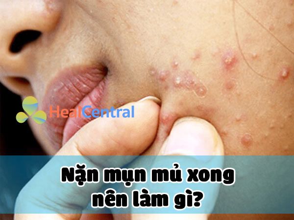 Nặn mụn mủ xong nên làm gì