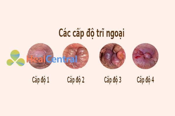 4 cấp độ của bệnh trĩ