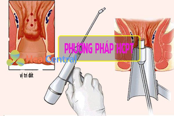 Phương pháp cắt trĩ HCPT