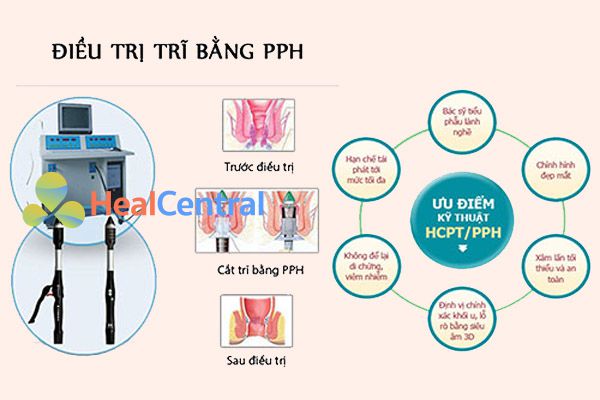 Phương pháp cắt trĩ PPH