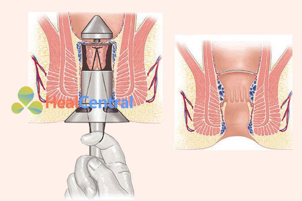 Cắt trĩ bằng phương pháp Longo