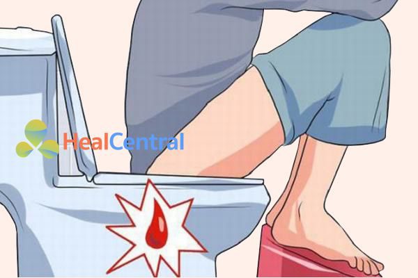 Bệnh trĩ: Nguyên nhân, biểu hiện, cách chữa bệnh
