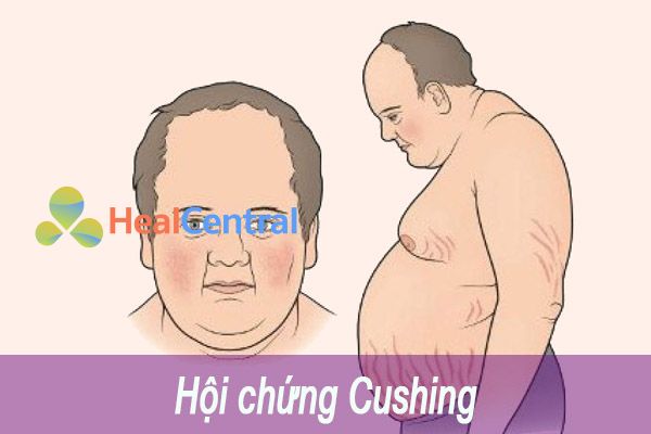 Bệnh nhân bị mắc hội chứng Cushing