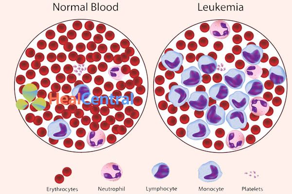 Leukemia (CML)