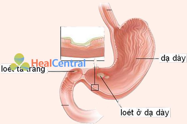 Thuốc Pantoloc chữa bệnh dạ dày