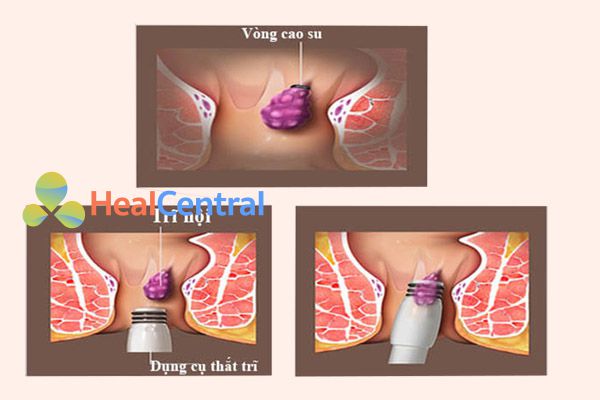 Phương pháp thắt búi trĩ bằng vòng cao su