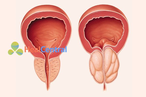 Tắc nghẽn đường niệu