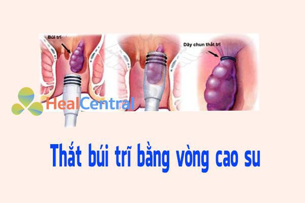 Thắt búi trĩ bằng vòng cao su