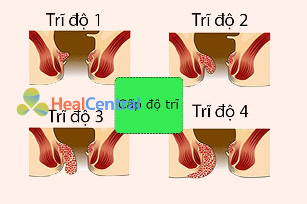 Các cấp độ trĩ.