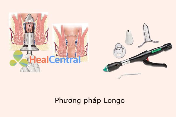 Cắt trĩ bằng phương pháp Longo.