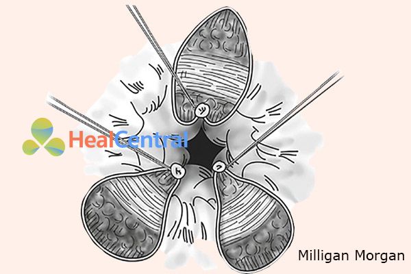 Cắt trĩ bằng phương pháp Milligan Morgan.