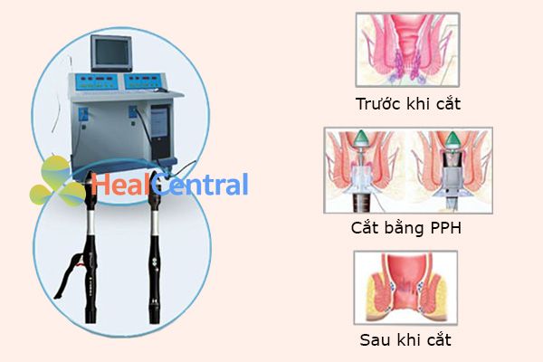 Cắt trĩ bằng phương pháp PPH.