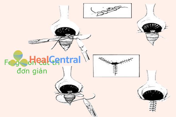Cắt trĩ bằng phương pháp Ferguson.