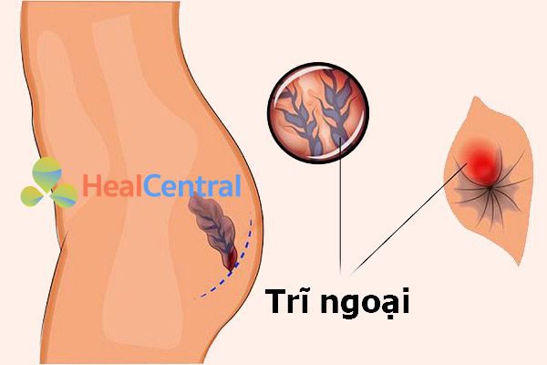 Bệnh nhân bị bệnh trĩ ngoại