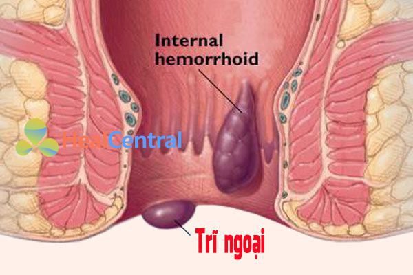 Trĩ ngoại