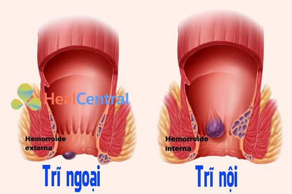 Bệnh trĩ nội và trĩ ngoại