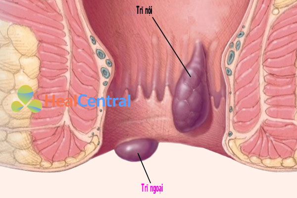 Bệnh trĩ nội khác với bệnh trĩ ngoại