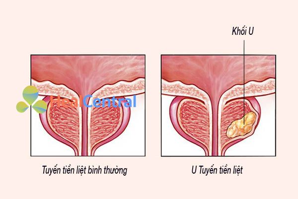 U tuyến tiền liệt