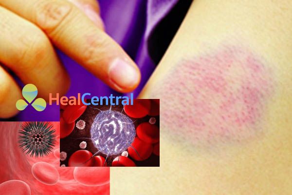 Condova có tác dụng trong điều trị Ung thư máu