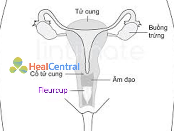 Ví trí đặt Cốc nguyệt san Fleurcup trong âm đạo