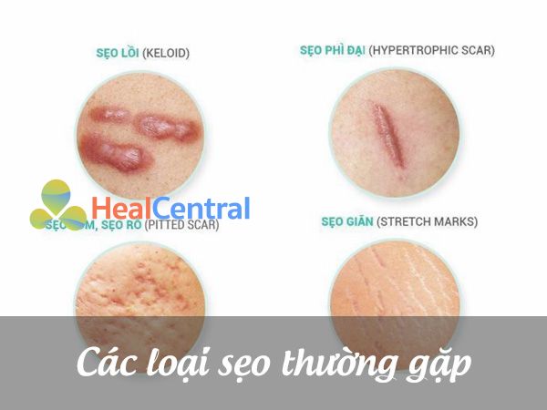 Cách nhận biết các loại sẹo thường gặp