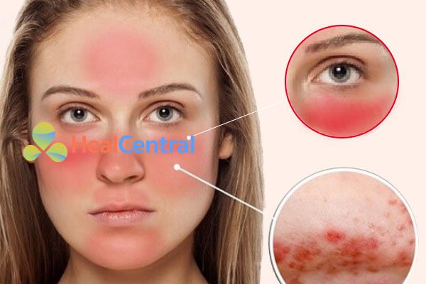 Ban đỏ hình cánh bướm đặc trưng của bệnh Lupus