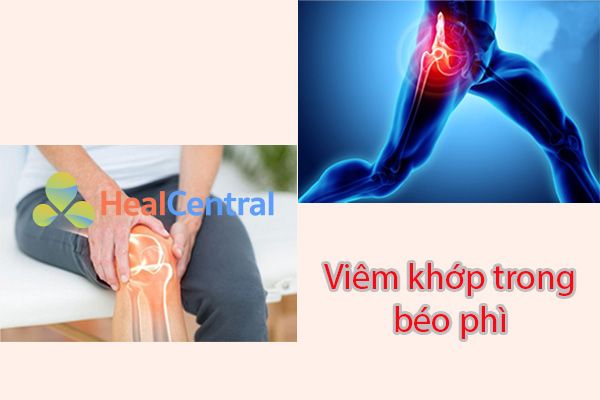 Béo phì làm gia tăng nguy cơ rất lớn dẫn đến viêm khớp gối và viêm khớp hông