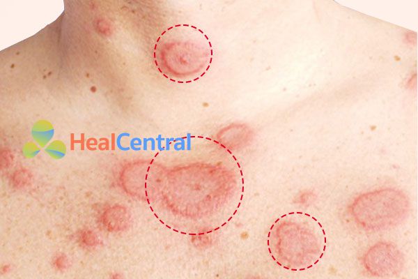 Các đốm đỏ xuất huyết của bệnh Lupus