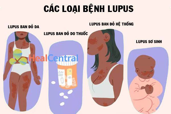 Các loại bệnh Lupus