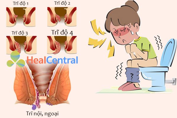 Phương pháp Longo áp dụng được cho tất cả các dạng trĩ