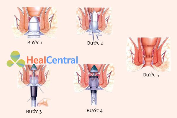 Các bước phẫu thuật cắt trĩ bằng phương pháp Longo