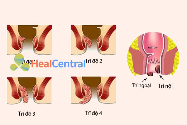 Các cách phân loại bệnh trĩ