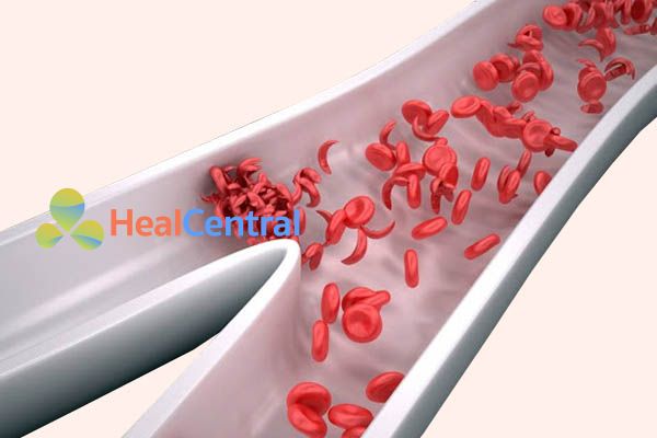 Hồng cầu hình liềm tiềm ẩn nguy cơ cao tắc mạch