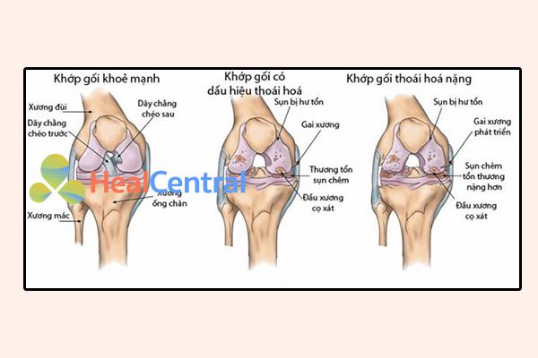 Khớp gối bình thường và khớp gối thoái hóa