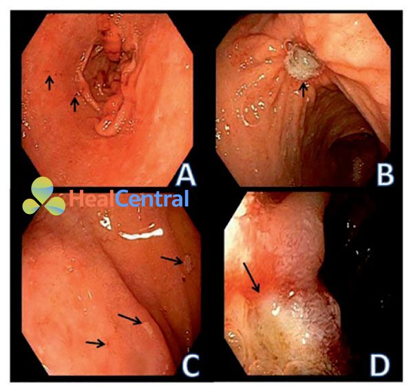 Hình 1. Loét và bào mòn ở dạ dày và thực quản. (A) Bào mòn hang vị dạ dày (nhỏ). Các mũi tên chỉ vào các chấm xuất huyết. (B) Loét dạ dày lành tính ở vùng thân dạ dày (vị trí mũi tên chỉ vào). (C) Bào mòn tá tràng. Mũi tên chỉ vào các điểm dịch tiết bám dính. (D) Loét tá tràng. Các vị trí mũi tên chỉ vào là các tổn thương niêm mạc, xung quanh niêm mạc có phù nề.