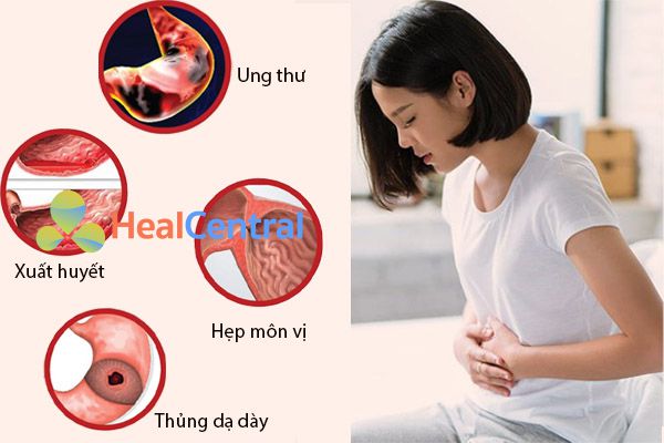 Những biến chứng nguy hiểm do loét dạ dày-tá tràng gây ra cho người bệnh