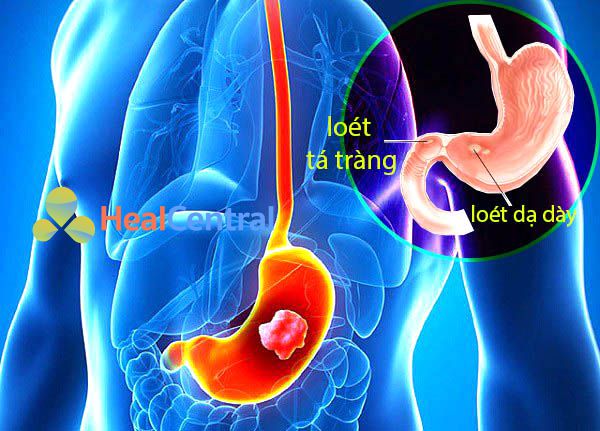 Loét dạ dày-Tá tràng: Nguyên nhân, triệu chứng, điều trị và phòng ngừa