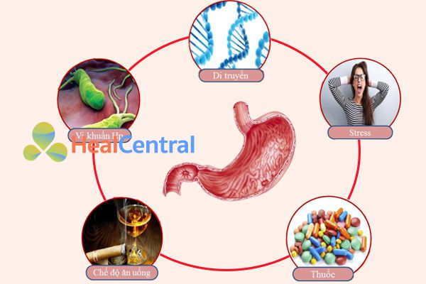 Các yêu tố nguy cơ khác gây loét dạ dày-tá tràng