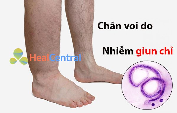 Bệnh chân vi ở người bị nhiễm giun chỉ