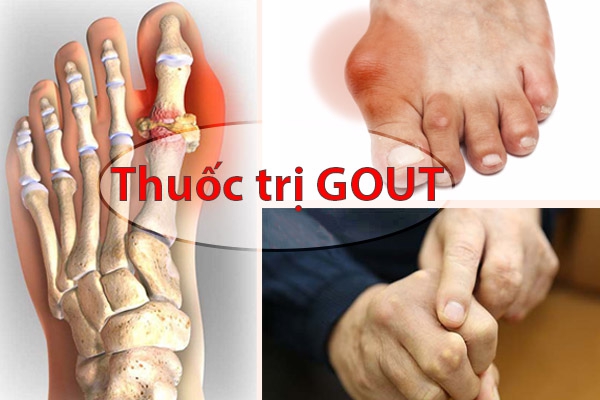 Các loại thuốc điều trị Gout tốt nhất hiện nay