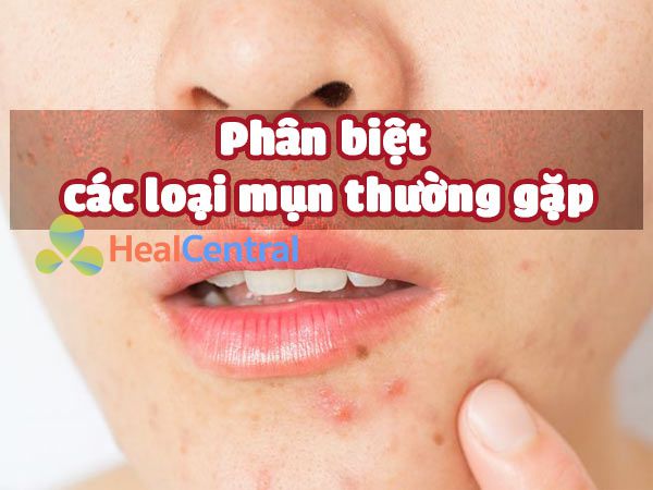 Phân biệt các loại mụn thường gặp