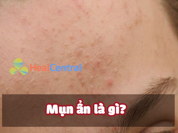 Mụn ẩn là gì?